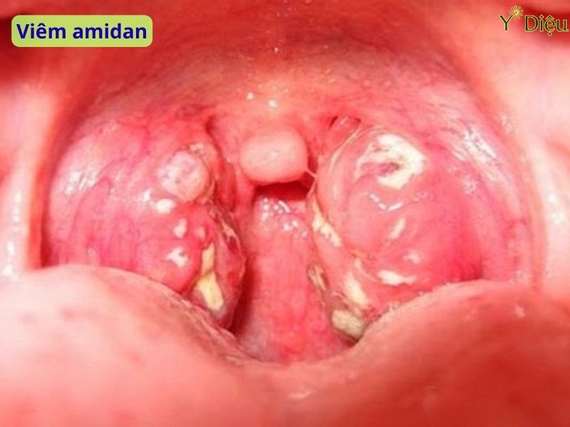 Viêm Amidan Là Gì? Nguyên Nhân, Và Cách Điều Trị Hiệu Quả